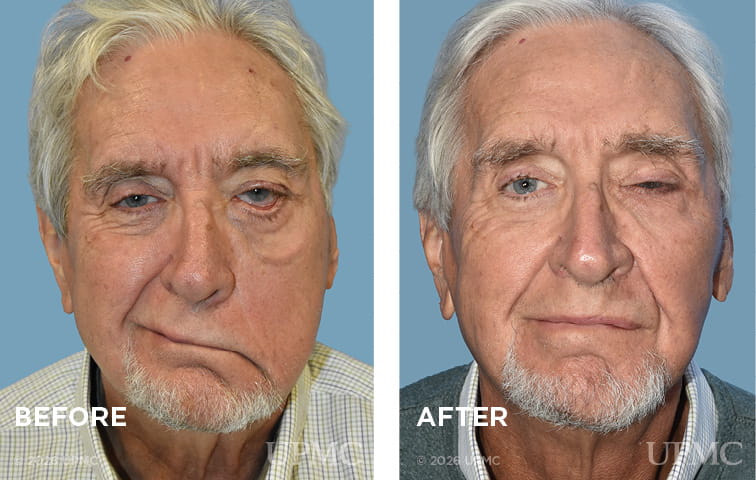 Fascia lata static suspension, lower lid tightening and placement of a platinum eyelid weight for flaccid facial paralysis following extirpation of a parotid tumor
